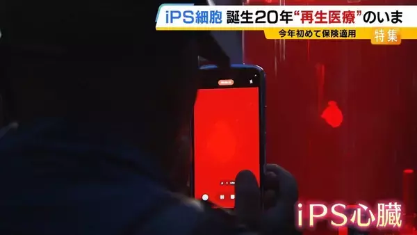 【iPS細胞】心臓病で“絶望”感じていた患者「問題なく生活できるように」　誕生から20年…高まる期待も「まだまだ道のり長い」究極の目的「広く普及させる」には？