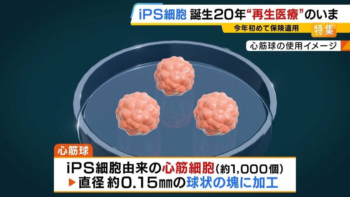 【iPS細胞】心臓病で“絶望”感じていた患者「問題なく生活できるように」　誕生から20年…高まる期待も「まだまだ道のり長い」究極の目的「広く普及させる」には？
