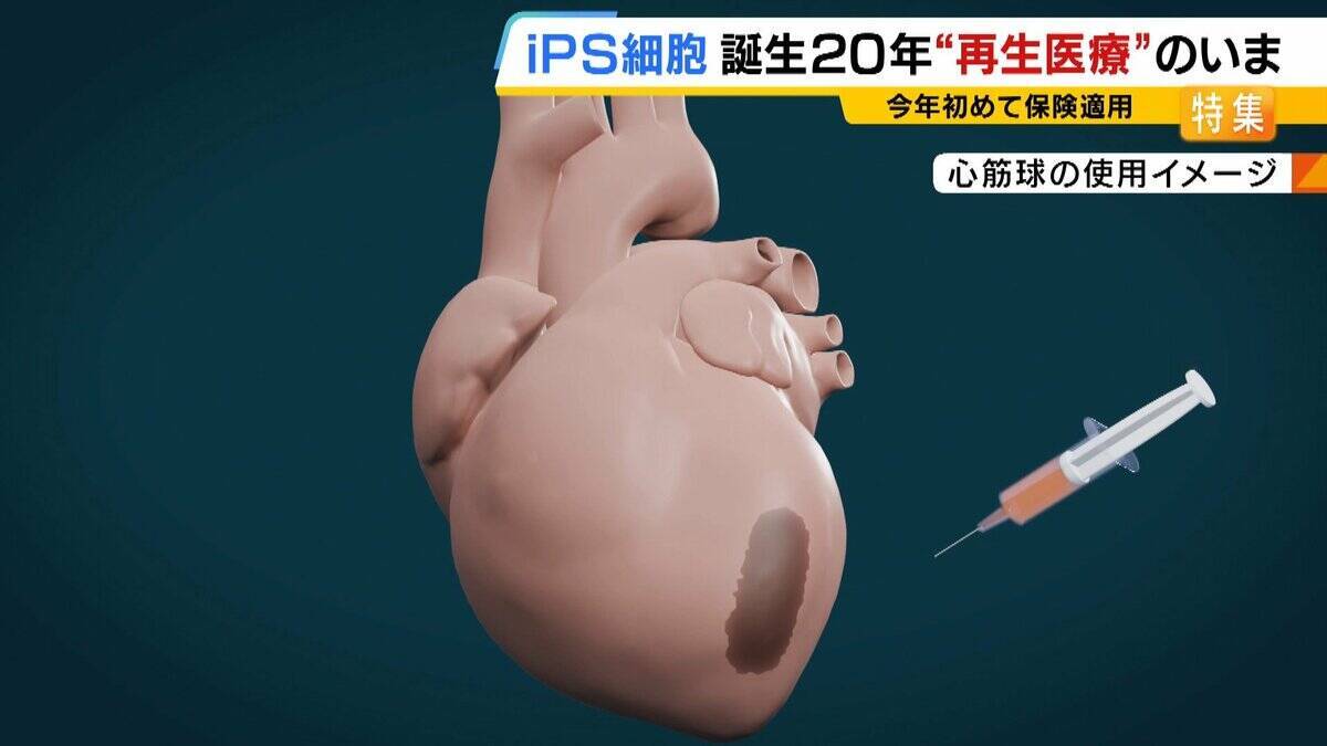 【iPS細胞】心臓病で“絶望”感じていた患者「問題なく生活できるように」　誕生から20年…高まる期待も「まだまだ道のり長い」究極の目的「広く普及させる」には？