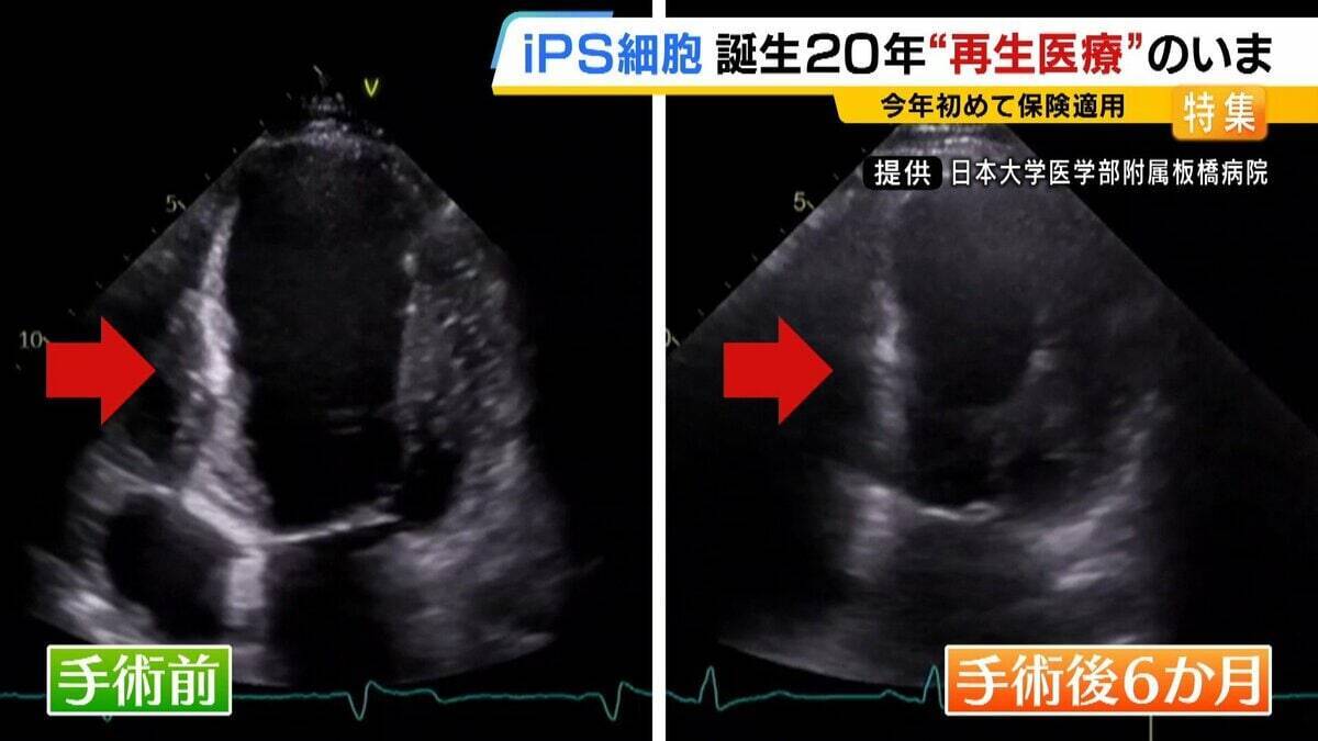 【iPS細胞】心臓病で“絶望”感じていた患者「問題なく生活できるように」　誕生から20年…高まる期待も「まだまだ道のり長い」究極の目的「広く普及させる」には？
