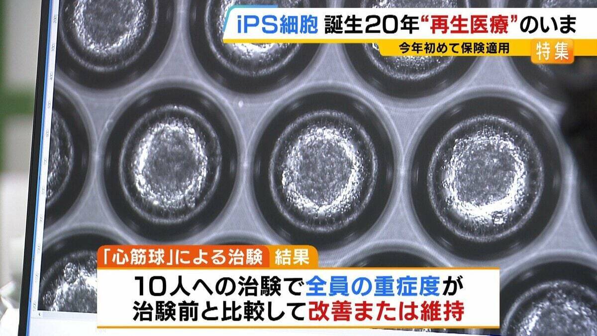 【iPS細胞】心臓病で“絶望”感じていた患者「問題なく生活できるように」　誕生から20年…高まる期待も「まだまだ道のり長い」究極の目的「広く普及させる」には？