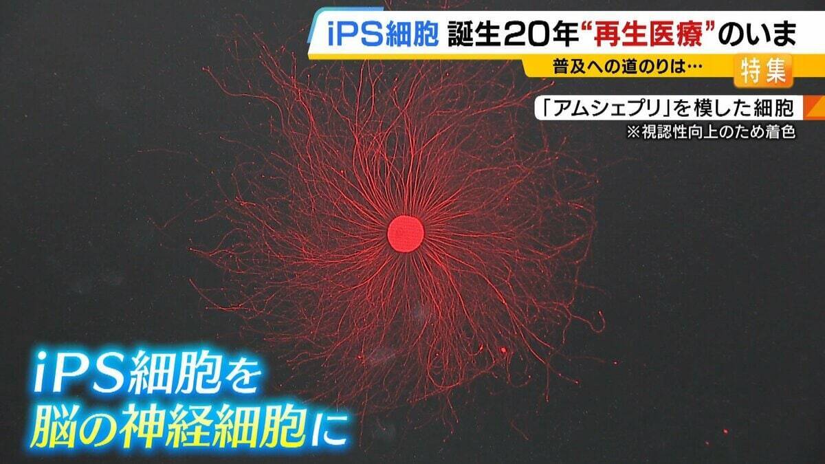 【iPS細胞】心臓病で“絶望”感じていた患者「問題なく生活できるように」　誕生から20年…高まる期待も「まだまだ道のり長い」究極の目的「広く普及させる」には？