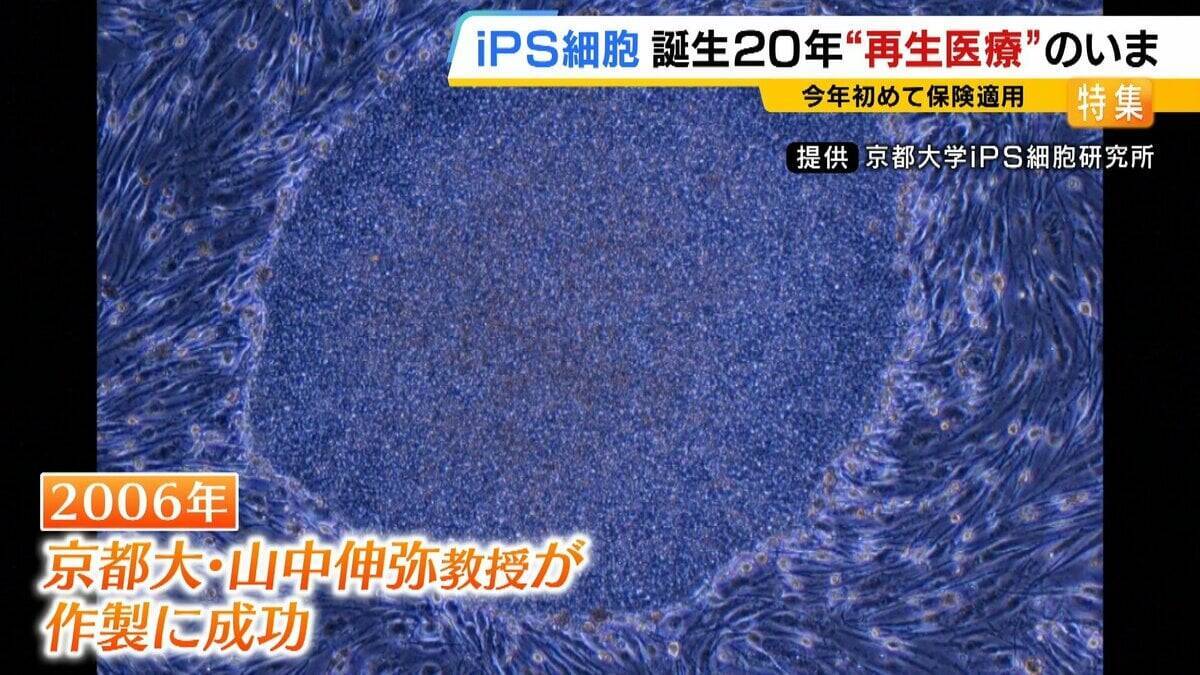 【iPS細胞】心臓病で“絶望”感じていた患者「問題なく生活できるように」　誕生から20年…高まる期待も「まだまだ道のり長い」究極の目的「広く普及させる」には？