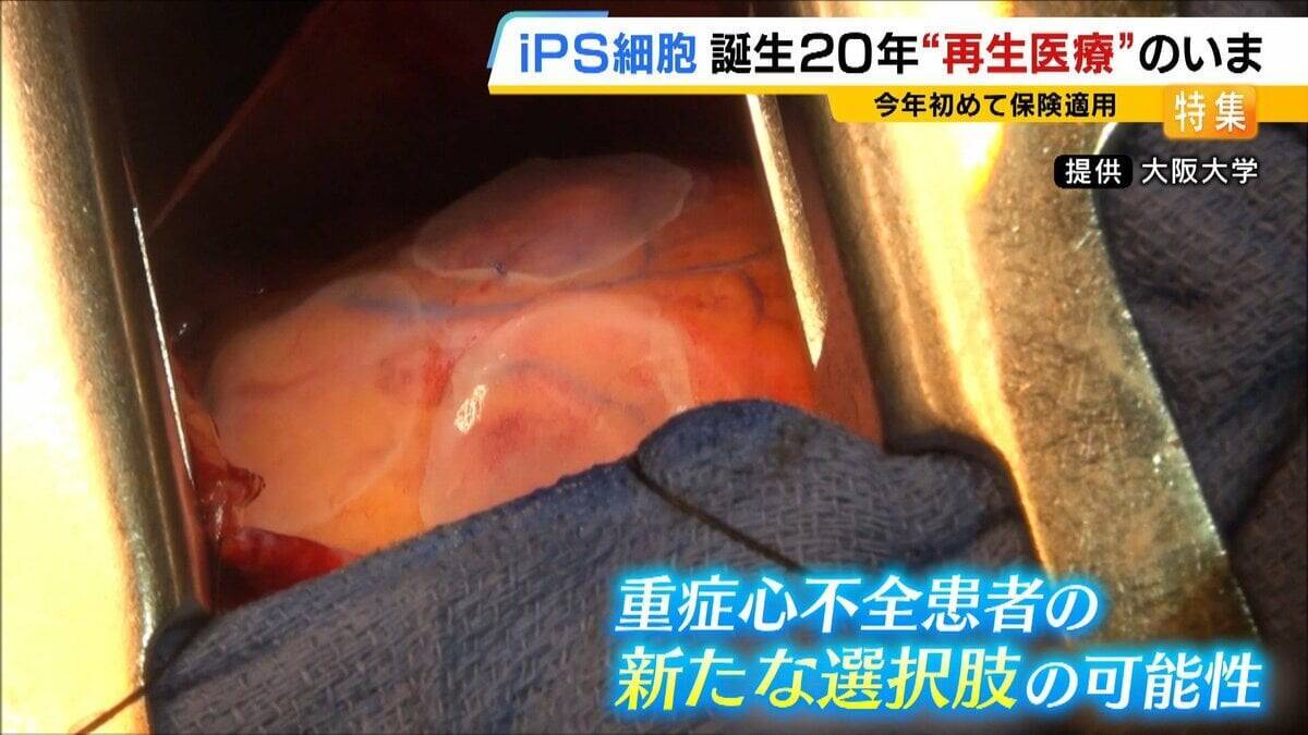 【iPS細胞】心臓病で“絶望”感じていた患者「問題なく生活できるように」　誕生から20年…高まる期待も「まだまだ道のり長い」究極の目的「広く普及させる」には？