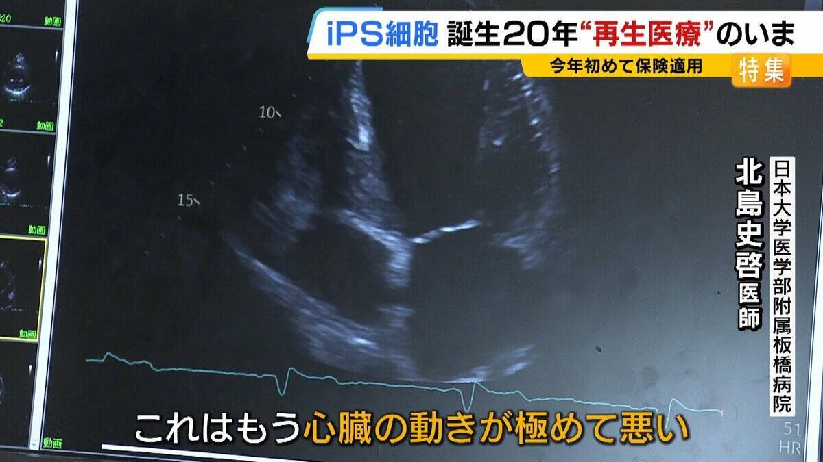 【iPS細胞】心臓病で“絶望”感じていた患者「問題なく生活できるように」　誕生から20年…高まる期待も「まだまだ道のり長い」究極の目的「広く普及させる」には？