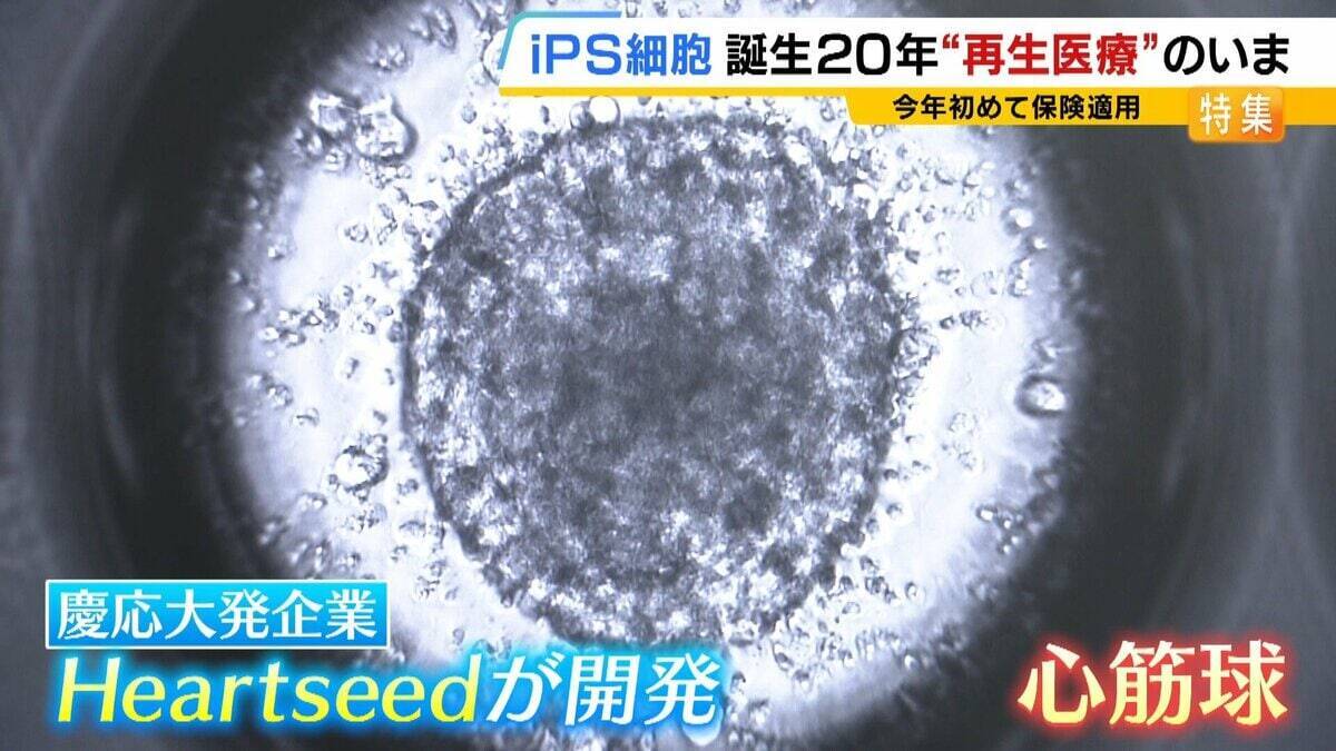 【iPS細胞】心臓病で“絶望”感じていた患者「問題なく生活できるように」　誕生から20年…高まる期待も「まだまだ道のり長い」究極の目的「広く普及させる」には？