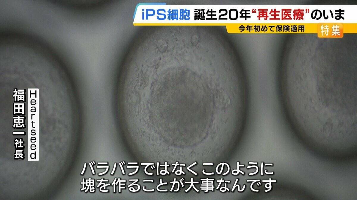 【iPS細胞】心臓病で“絶望”感じていた患者「問題なく生活できるように」　誕生から20年…高まる期待も「まだまだ道のり長い」究極の目的「広く普及させる」には？