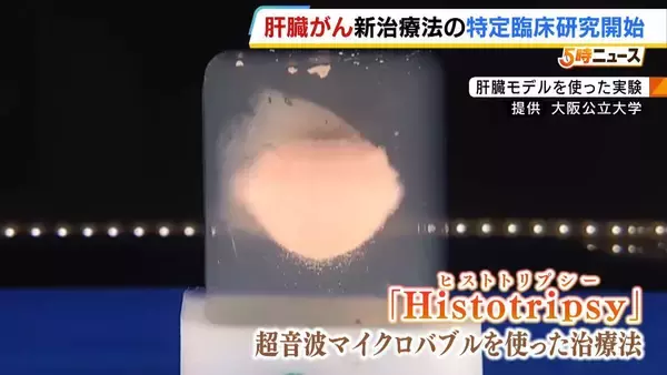 衝撃波で腫瘍を破壊「メスも針も使わない」肝臓がんの新治療法　大阪公立大の研究チームが特定臨床研究を開始　来年中の薬事承認を目指す