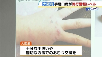 【手足口病】大阪府でも「警報レベル」超え　十分な手洗いや適切な方法でのおむつ交換を呼びかけ　近畿では京都府・兵庫県・奈良県でも「警報レベル」超え