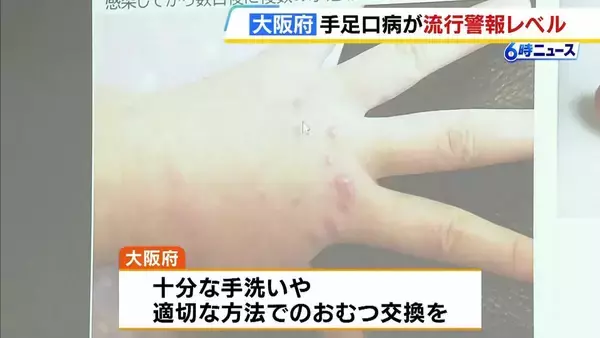 【手足口病】大阪府でも「警報レベル」超え　十分な手洗いや適切な方法でのおむつ交換を呼びかけ　近畿では京都府・兵庫県・奈良県でも「警報レベル」超え