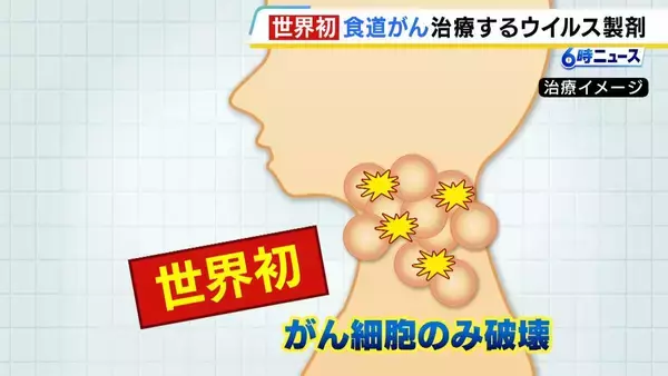 「うまくいけば仕事しながら治療できる」“世界初”食道がんのウイルス製剤「テロメライシン」販売開始　薬価約930万円も保険適用の対象に