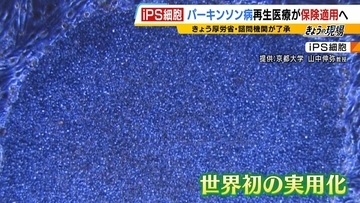 【iPS細胞】誕生から20年の時を経て実用化へ　細胞由来のパーキンソン病治療薬の保険適用了承　高まる期待も実は数々のハードルが…医療ジャーナリストが解説
