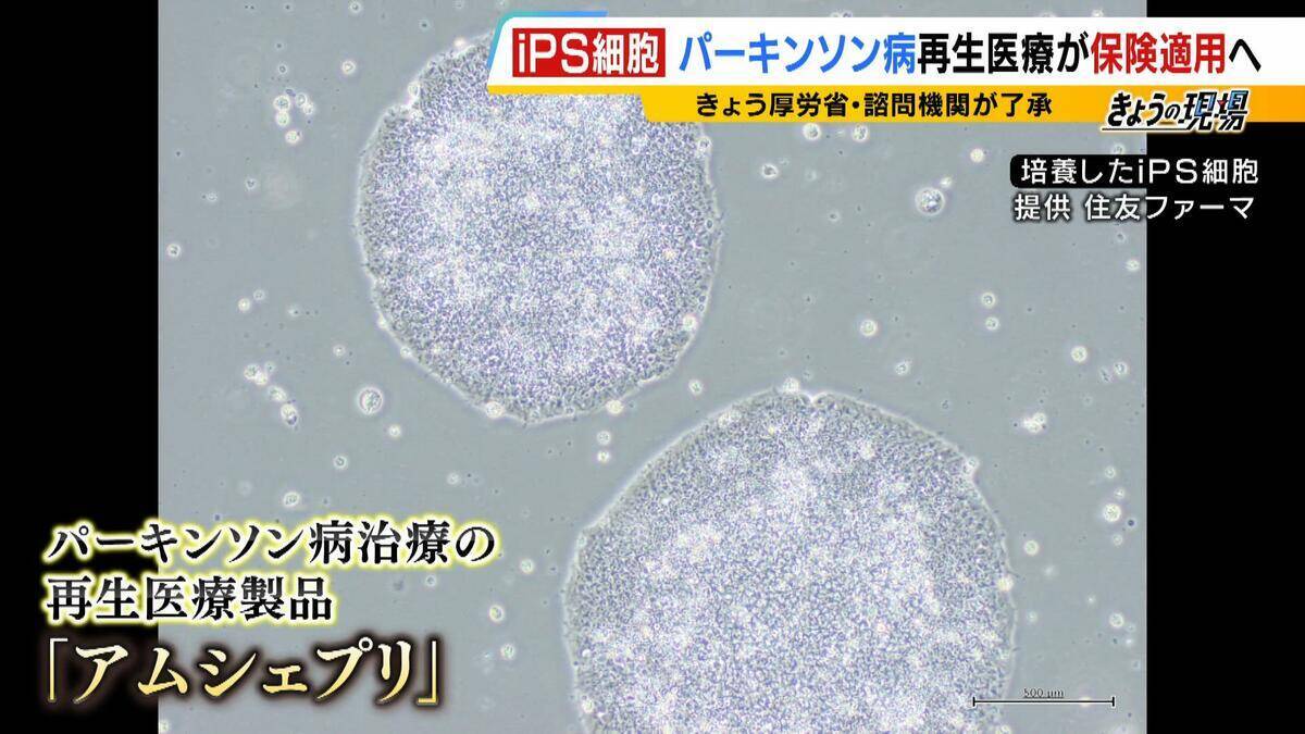【iPS細胞】誕生から20年の時を経て実用化へ　細胞由来のパーキンソン病治療薬の保険適用了承　高まる期待も実は数々のハードルが…医療ジャーナリストが解説