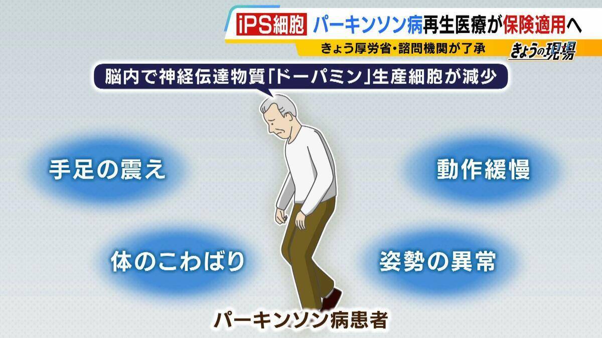 【iPS細胞】誕生から20年の時を経て実用化へ　細胞由来のパーキンソン病治療薬の保険適用了承　高まる期待も実は数々のハードルが…医療ジャーナリストが解説