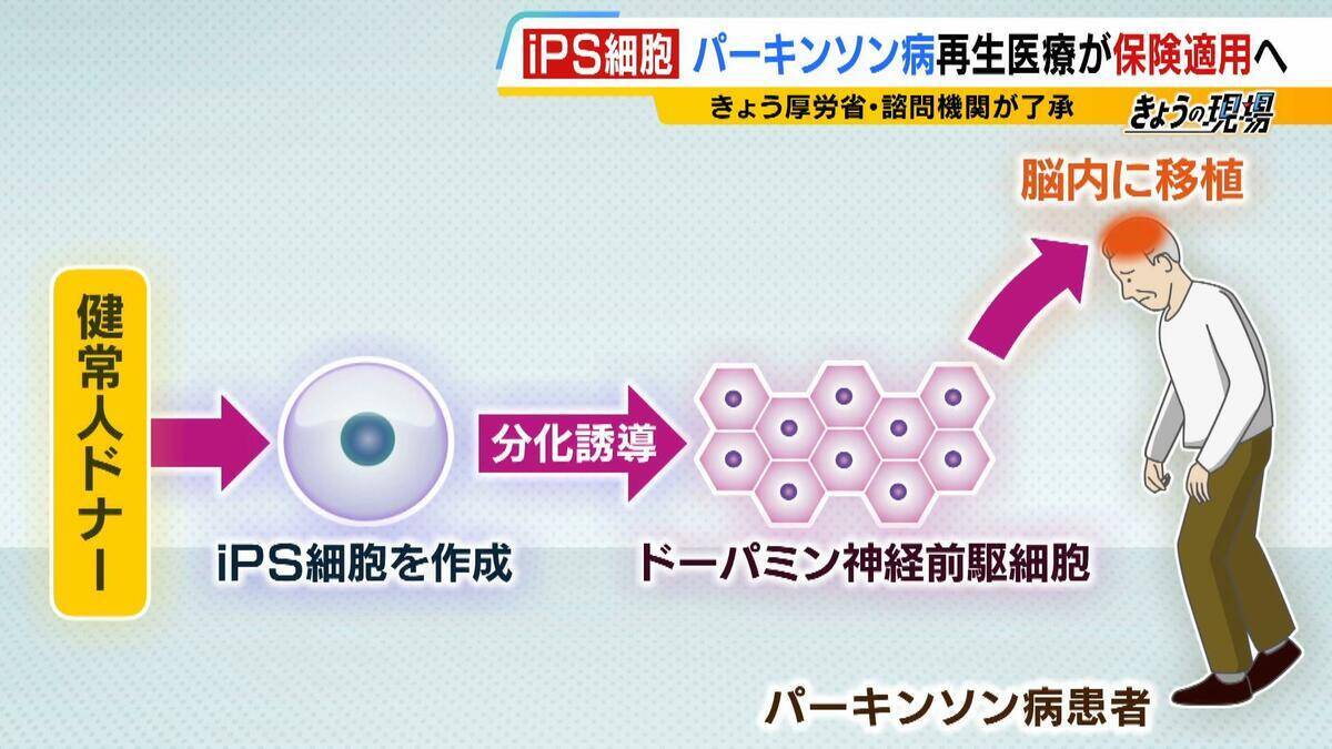【iPS細胞】誕生から20年の時を経て実用化へ　細胞由来のパーキンソン病治療薬の保険適用了承　高まる期待も実は数々のハードルが…医療ジャーナリストが解説