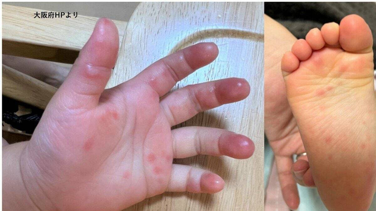 【手足口病に注意】感染者が前の週から63％増！おむつ交換後にはしっかり手洗いを　暑くなる季節…O157など腸管出血性大腸菌感染症にも注意を