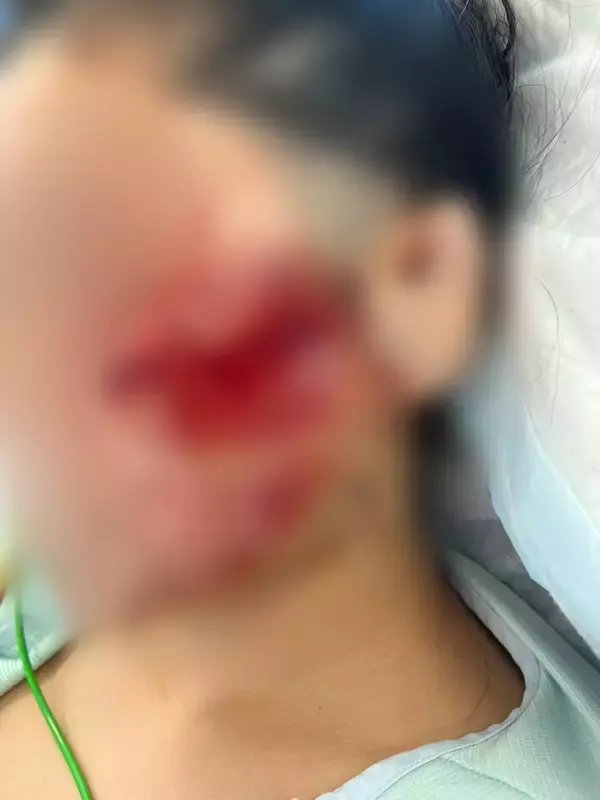 「「地獄に突き落とされた感覚。こんな傷だらけになってしまって…」美容が好きだった20代女性　飲酒運転で二度と戻らなくなった顔と身体　念願の留学も白紙に…　被告の28歳女は酒に酔ったままハンドル握り…　危険運転致傷罪で起訴」の画像