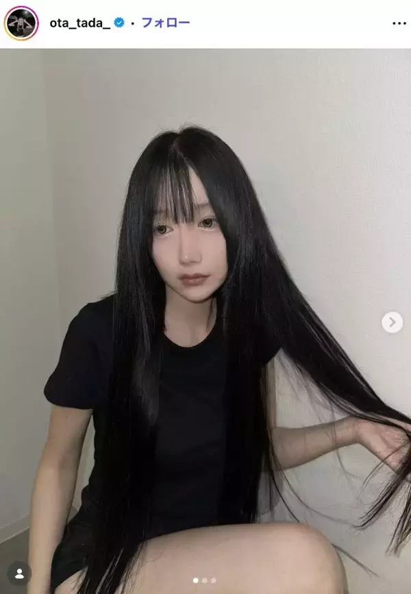 「月曜から夜ふかし」多田さん「残り10日で術後1ヶ月です」ノーマルカメラで整形DTの経過報告「強さに感動」「早く良くなりますように」と反響