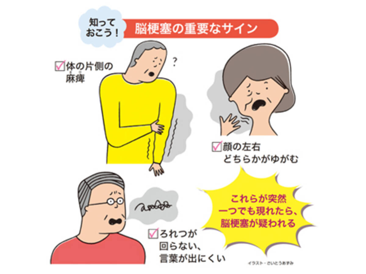 こんな症状が出たら注意 脳梗塞が起こると現れるサインを見逃すな 14年1月3日 エキサイトニュース