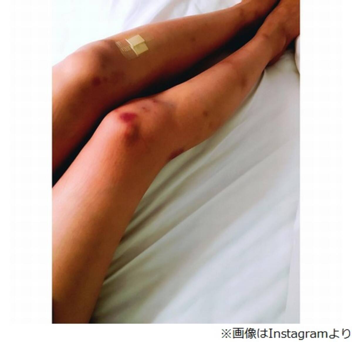 有村架純 傷だらけの脚 に反響 16年9月16日 エキサイトニュース