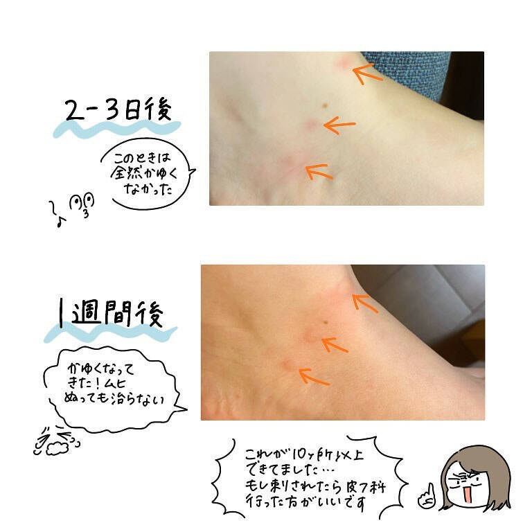 【ヤバい虫の悪夢②】虫に刺されたけど全然かゆくな～い♪放置した結果…現れし症状とは!?【momo漫画】