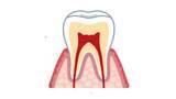 「歯を抜かずに残せる可能性も　進化する根管治療　新技術で再発防止と負担軽減」の画像1