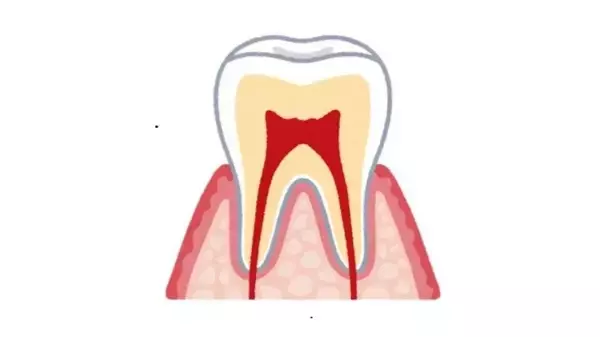 歯を抜かずに残せる可能性も　進化する根管治療　新技術で再発防止と負担軽減
