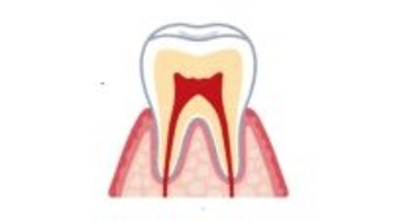 歯を抜かずに残せる可能性も　進化する根管治療　新技術で再発防止と負担軽減