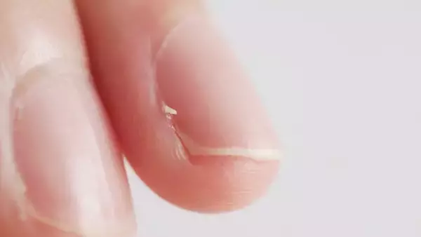 “ささくれ”悪化、炎症や「赤い線」が現れたら要注意、リンパ管炎になることも