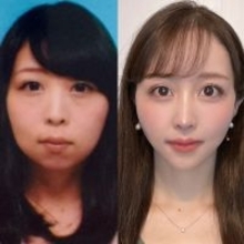 「あいつ顎ないよな」「化け物」心無い言葉が、外見コンプレックスに…整形で女性たちが得られたものとは？