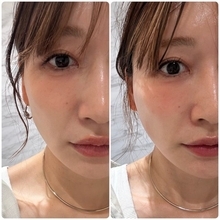 41歳・あいのり桃、糸リフト施術後の変化　投稿に「before→afterの違いが凄い!!」「すごい！シュッとしている！」