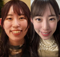 【整形美女】人前で自然に笑えない…整形を決意したフォトグラファー「外見が変わったというより、心が軽くなった」