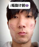 「マスクで激荒れ…6年におよぶニキビ治療を諦めなかった男性「努力の賜物」「めちゃくちゃ垢抜けてますね！」」の画像1