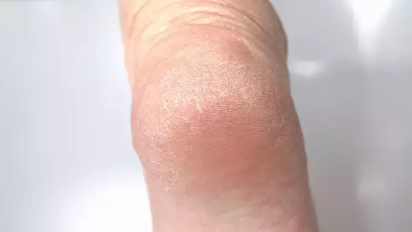 触った瞬間ゾッとする…「岩化かかと」になる前にやるべき冬の角質・保湿対策