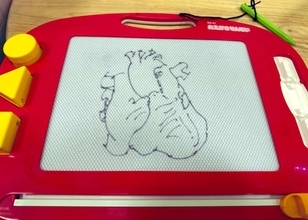 子どもに「ハート描いて」と頼まれた心臓外科医　ガチすぎる“ハート”を描き上げる