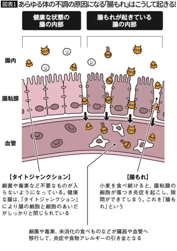 「腸の壁に穴が空き､全身がボロボロに…内科医が｢毎日食べてはダメ｣と警告する"みんな大好きな朝食の定番"【2026年4月BEST】」の画像