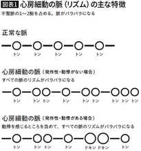 ｢トン-トントン｣と乱れる脈に要注意…長嶋茂雄､小渕恵三元総理の脳梗塞につながった｢心房細動｣の危険信号