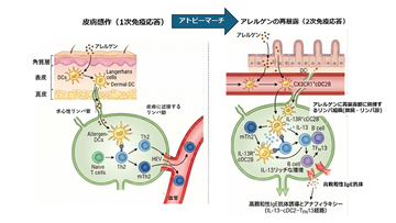アトピー性皮膚炎を発端に症状が全身に拡大する「アトピーマーチ」のメカニズムを解明 ～IL-13と特定の樹状細胞の相互作用が高親和性IgE抗体産生を駆動する～