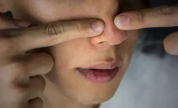 ■【男性9,419名の調査で判明】「毛穴」に悩む男性多数も 治療認知度はわずか16.3％ ／ 毛穴治療の普及目指し9,800円で試せる「ダーマペントライアル（塗る麻酔込み）」を開始