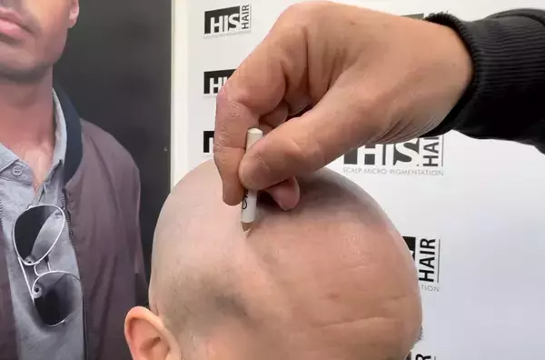 「「毎朝、鏡を見るのが怖くなくなった」薄毛に悩む人に寄り添う、頭皮アートメイク専門看護師・吉田れいの想い」の画像