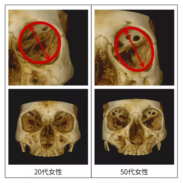 顔のたるみは「肌」ではなく「骨」が原因！？
