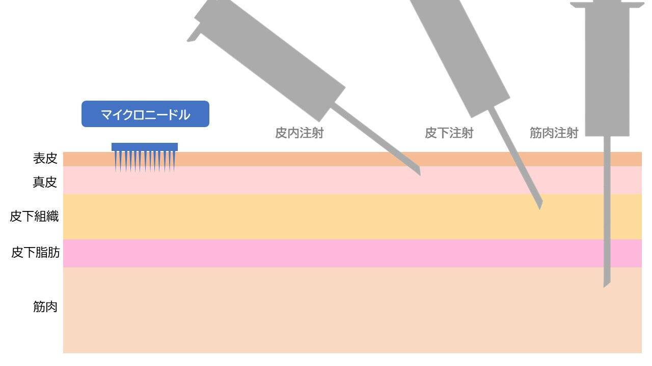 注射に代わるマイクロニードルは「痛くない」だけなのか？高校二年生が探求した「やさしい医療」