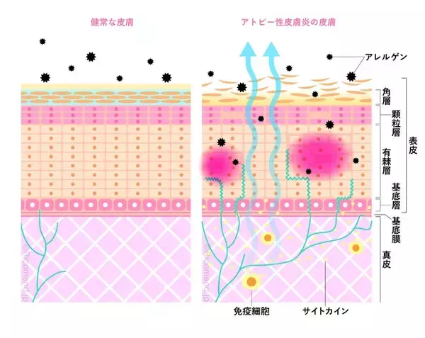 アトピー性皮膚炎治療に新たな知見！　世界最小＊1「ナノサイズ微細水粒子AIR（アイル）」がアトピー性皮膚炎の症状を緩和する可能性