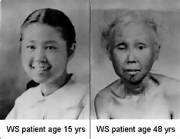 20歳過ぎから急速に老化する「早老症ウェルナー症候群」の全国疫学調査を実施し、実態の把握へ