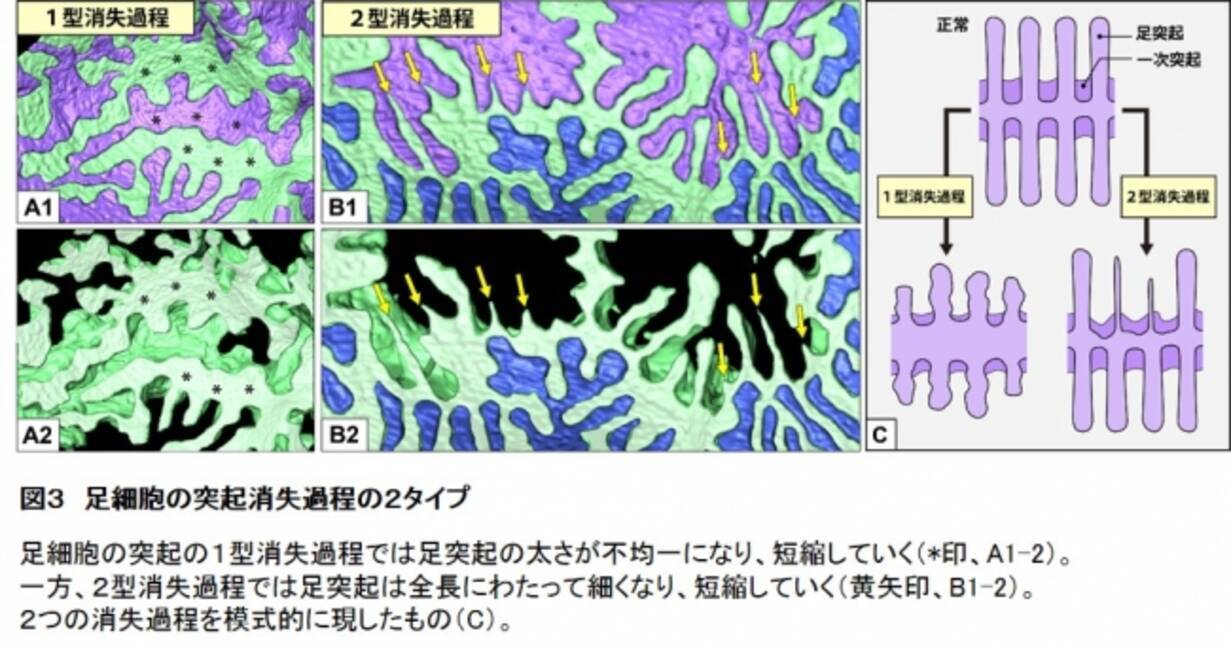 腎疾患における糸球体障害の形態変化の全過程を明らかに 19年1月28日 エキサイトニュース