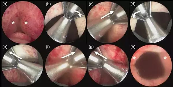 新たな前立腺肥大症に対する低侵襲手術「経尿道的前立腺吊上術（ウロリフト）」とは？