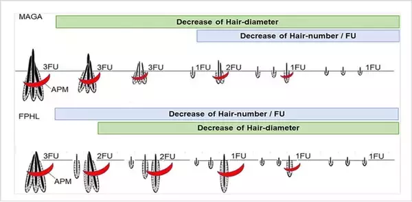 男性型脱毛症と女性型脱毛症の進行経路の違いが判明　トリコスコピー（毛や毛包周囲を拡大鏡によって診断する方法）による臨床研究
