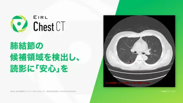 胸部CT画像診断支援AI「EIRL Chest CT」、計測機能の拡充機能等を追加した新モデルを発売