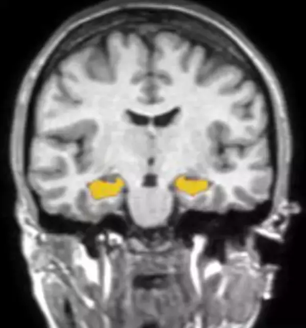 東北大学 加齢医学研究所 発ベンチャーのCogSmart、“海馬を育てる”日本発ソリューションの展開のため、株式投資型クラウドファンディングを実施
