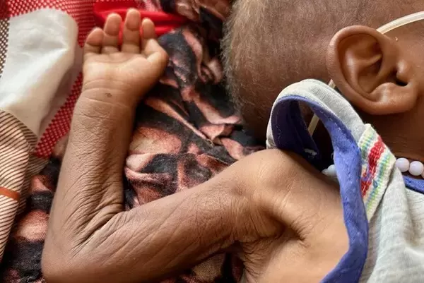 スーダン：長引く紛争で極度の栄養失調が広がる──人道援助の拡充が不可欠